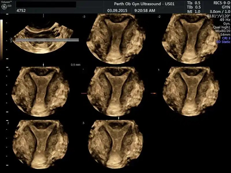 Pelvic Ultrasound POGU