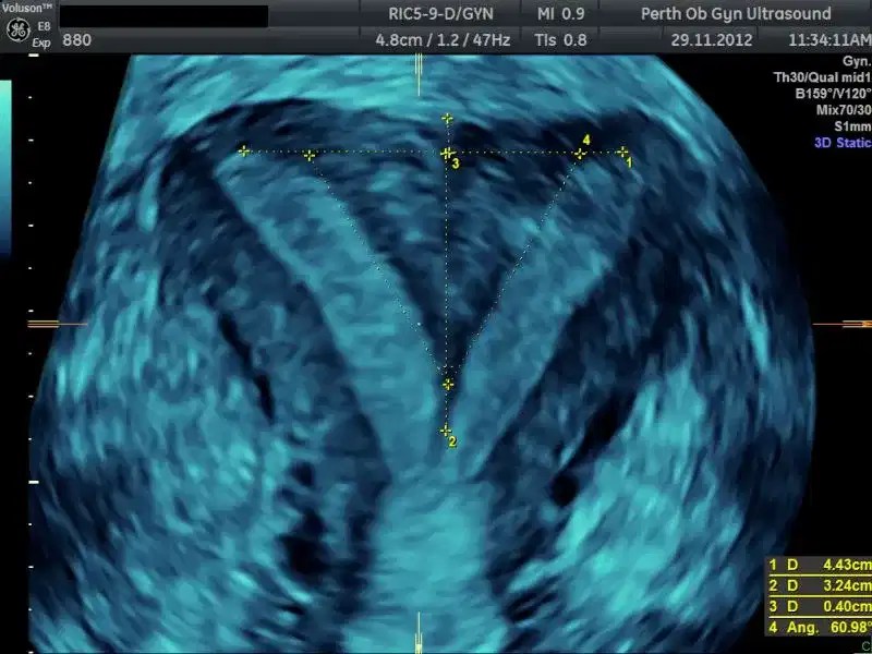 Pelvic Ultrasound POGU