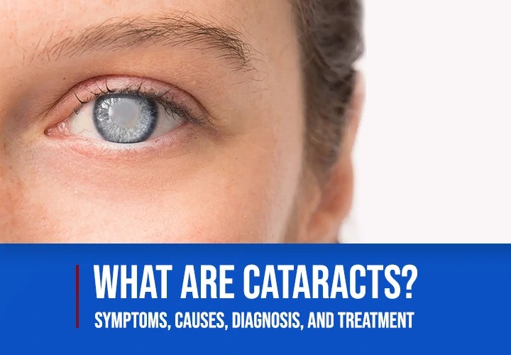 What are Cataracts? Symptoms, Causes, Diagnosis, and Treatment