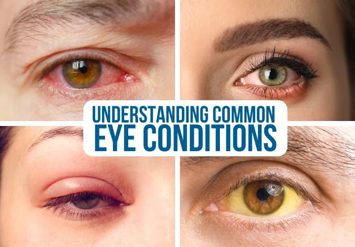 Insights on Eye Conditions Symptoms and Treatments Guide