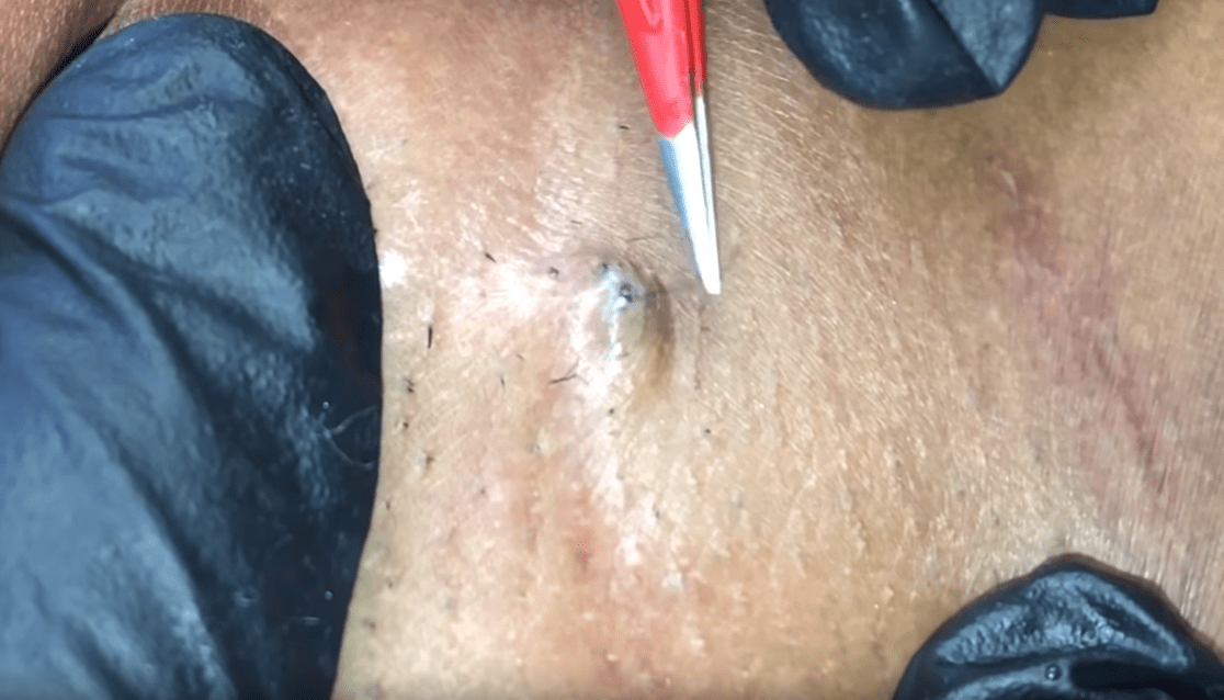 Lots of Ingrown Hairs and Follicles Removed New Pimple Popping Videos