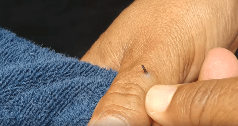 How To Remove Finger Hair / Remove a Splinter Under Your Fingernail
