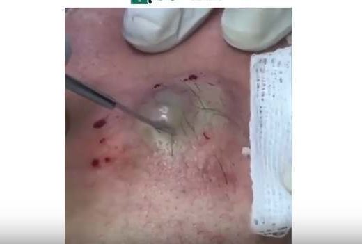 newest youtube videos infected painful boils New Pimple Popping Videos