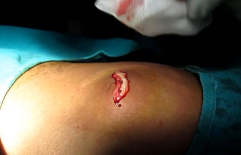 Sebaceous Cyst In The Back Drained New Pimple Popping Videos