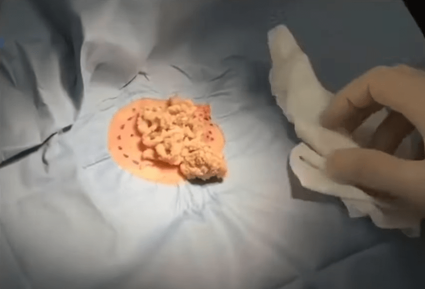 2021 cyst. New Pimple Popping Videos
