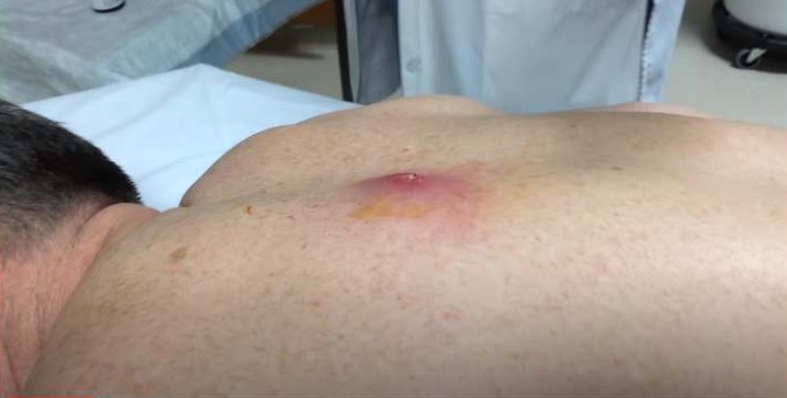Draining Large Cyst On The Back New Pimple Popping Videos