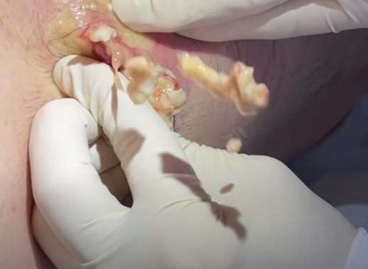 massive boils bursting Archives New Pimple Popping Videos