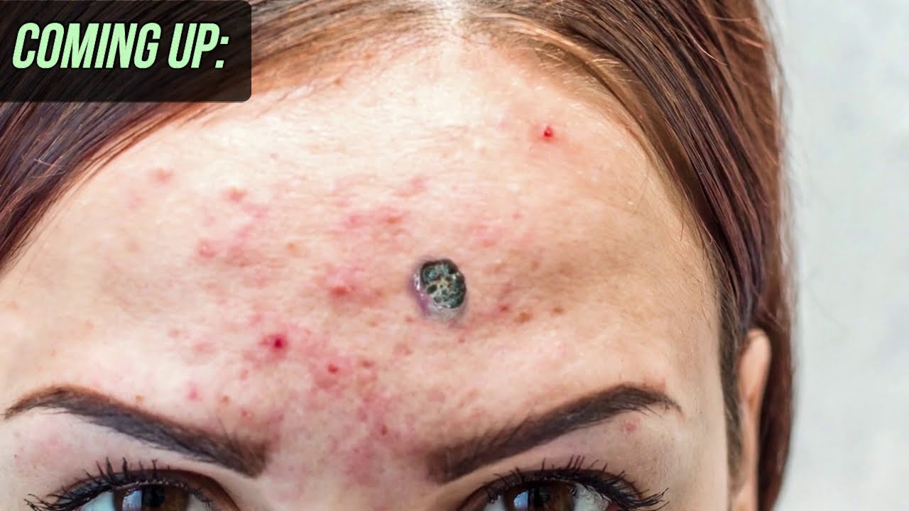 Pimple Compilation Pop That Zit Since 2006!(02)