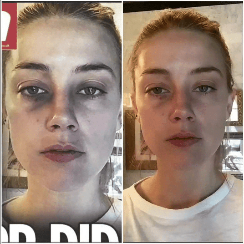 The Sun photoshopped Amber Heard fake injuries/abuse pictures
