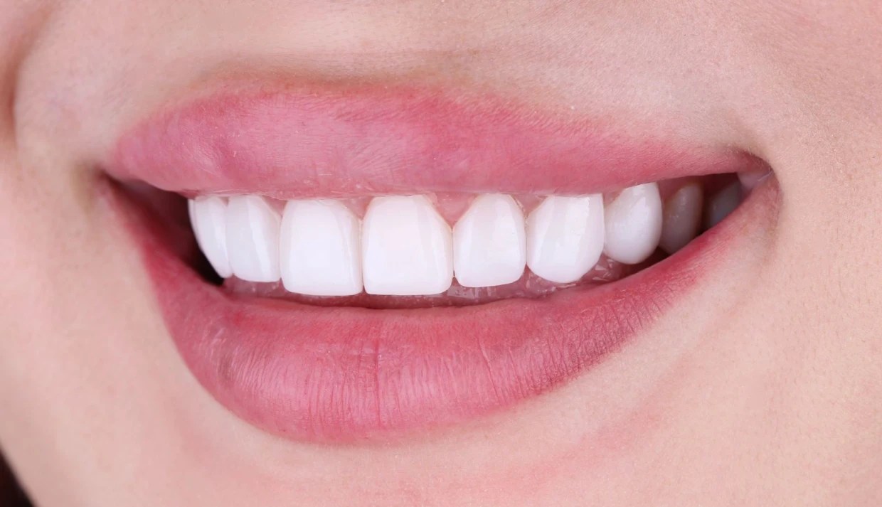 Home Porcelain Veneers México