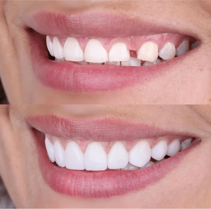 Home Porcelain Veneers México