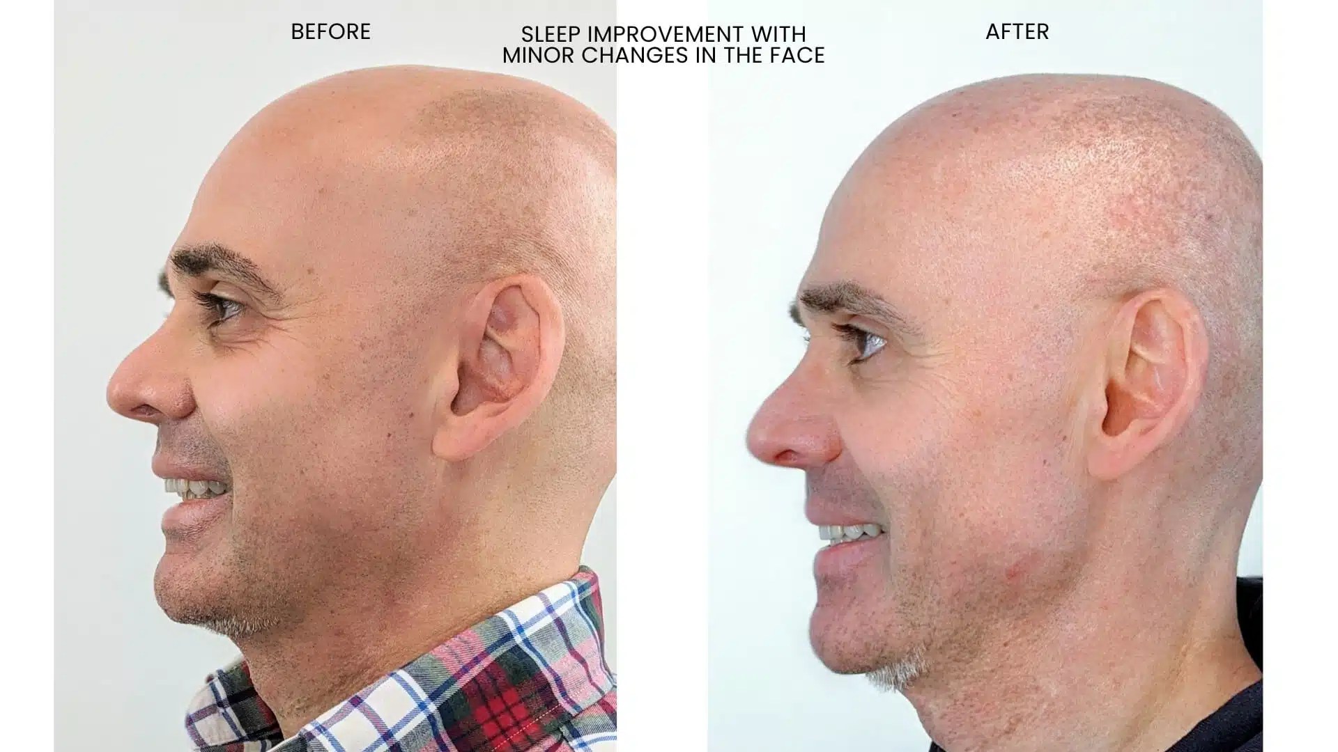 All you need to know about jaw surgery and orthodontic treatment