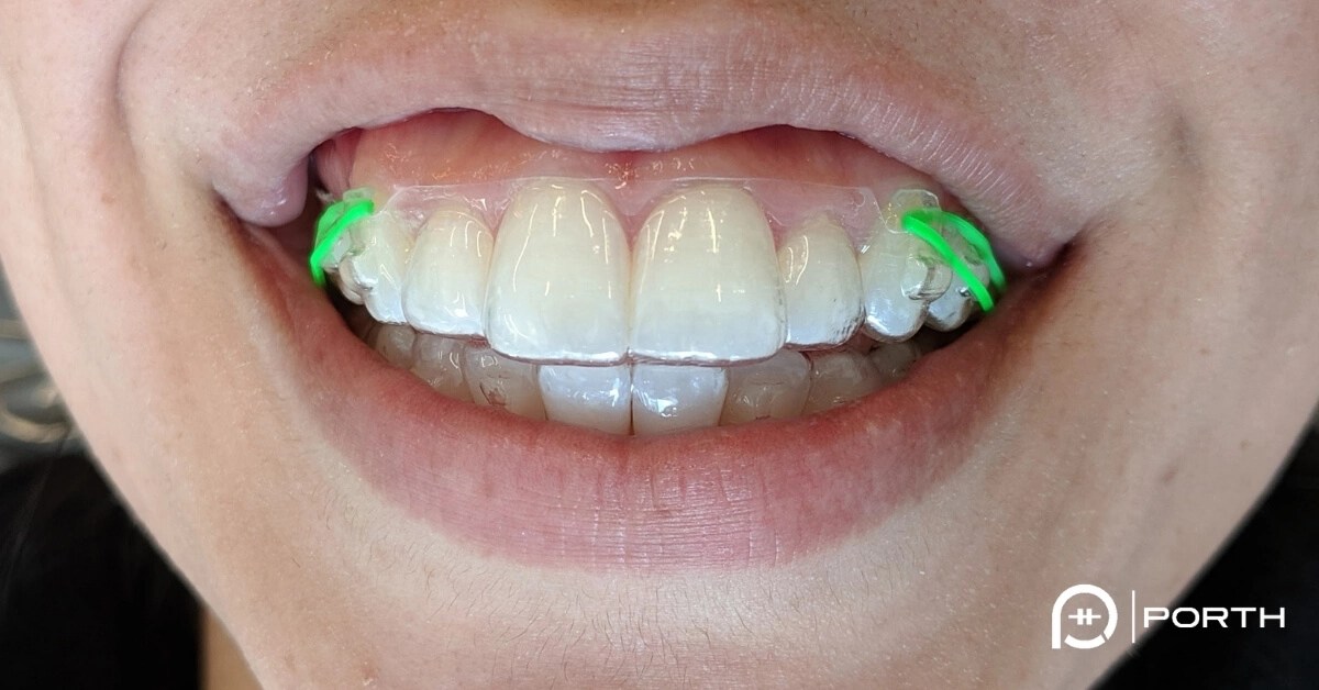Elastics on Invisalign or Clear Aligners Modern Orthodontic Clinic in