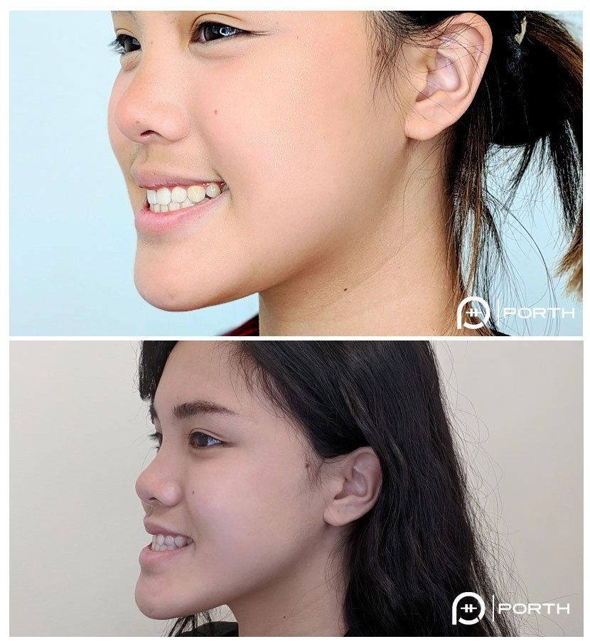 Everything You Need To Know About Double Jaw Surgerym vrogue.co(04)