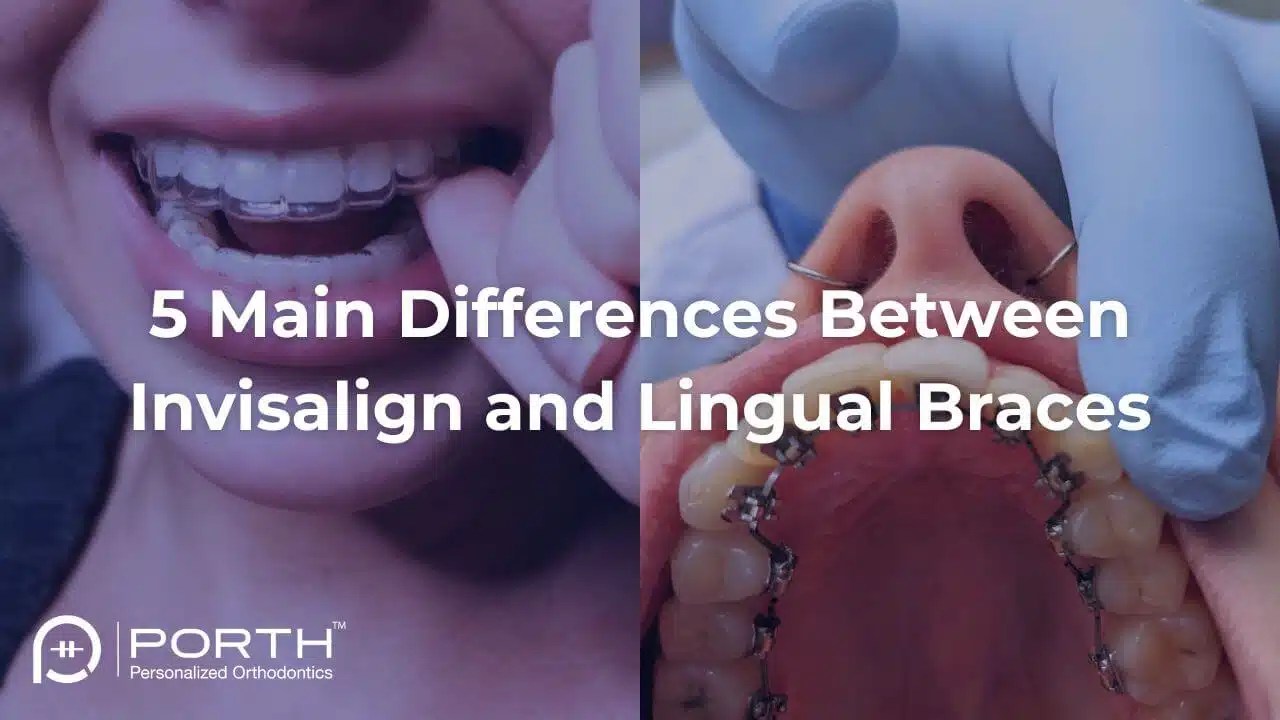5 main differences between Invisalign and lingual braces
