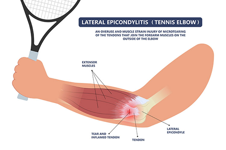 Lateral epicondylitis (Tennis Elbow) Perth Orthopaedic Specialist Centre