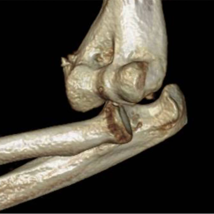 Elbow Instability Perth Orthopaedic Specialist Centre