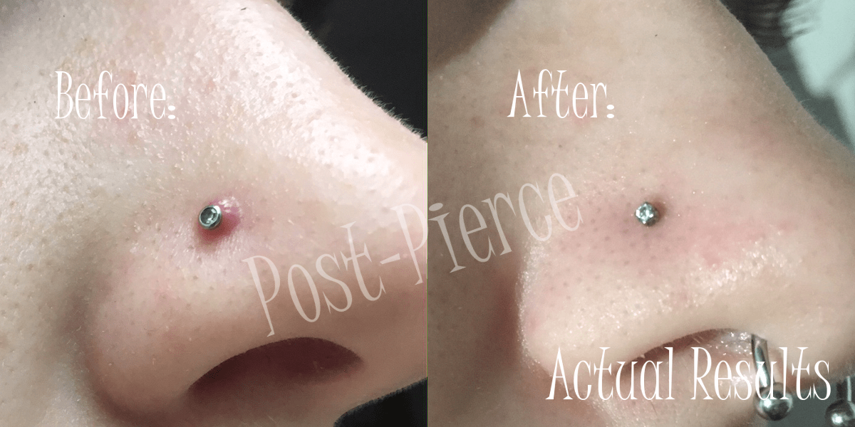 PostPierce is applied, with the included personal applicator wand