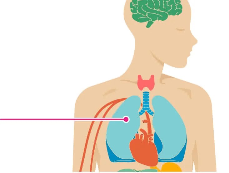 The Effects of Pneumonia on the Body