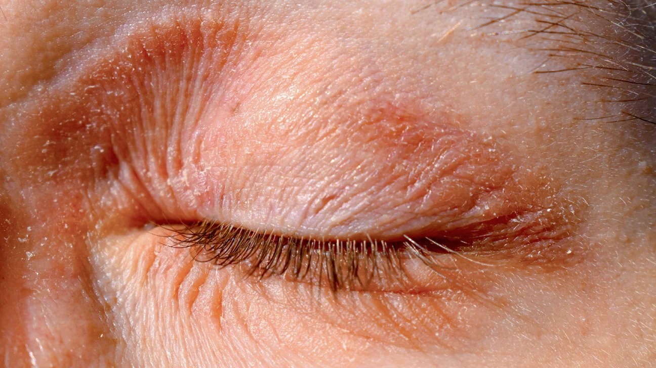 Eczema On The Eyes Causes, Symptoms, and Treatment