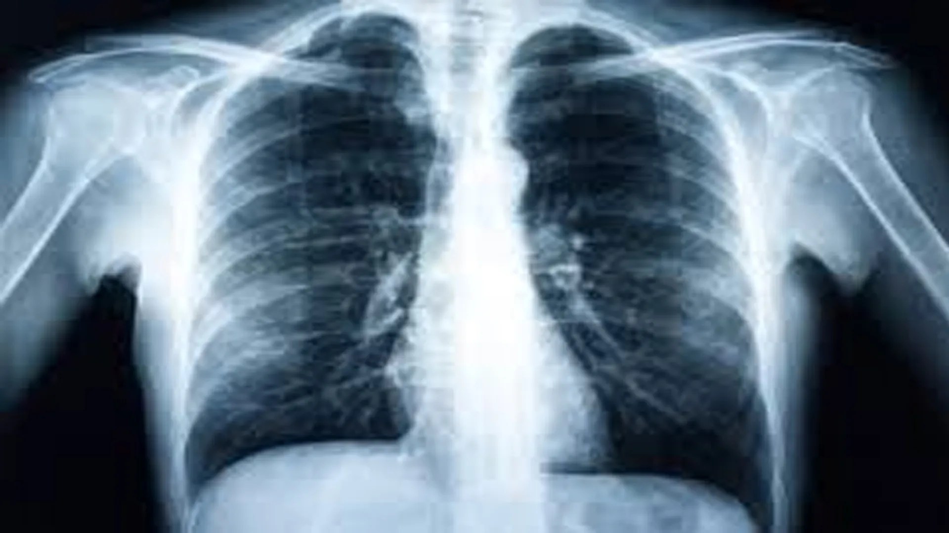 New hope for cystic fibrosis treatment Post Courier