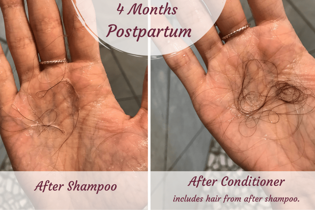 Why Postpartum Hair Loss is NOT Normal (With Photos) Postpartum