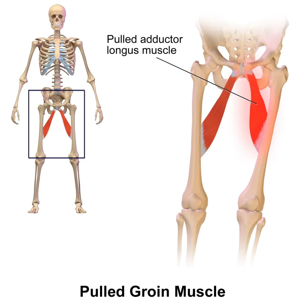 Groin Strains Treatment and Recovery PowerBuild Noble Park