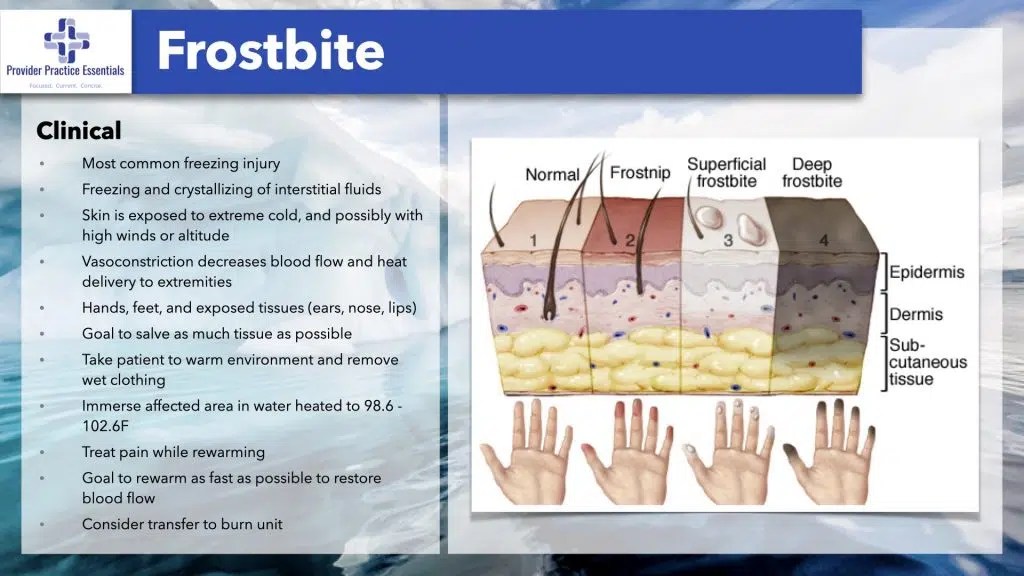 What to know about Frostbite! PPE Medical