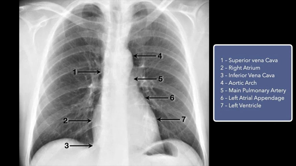 Basic Chest XRay Interpretation Tips and pointers to see it all!