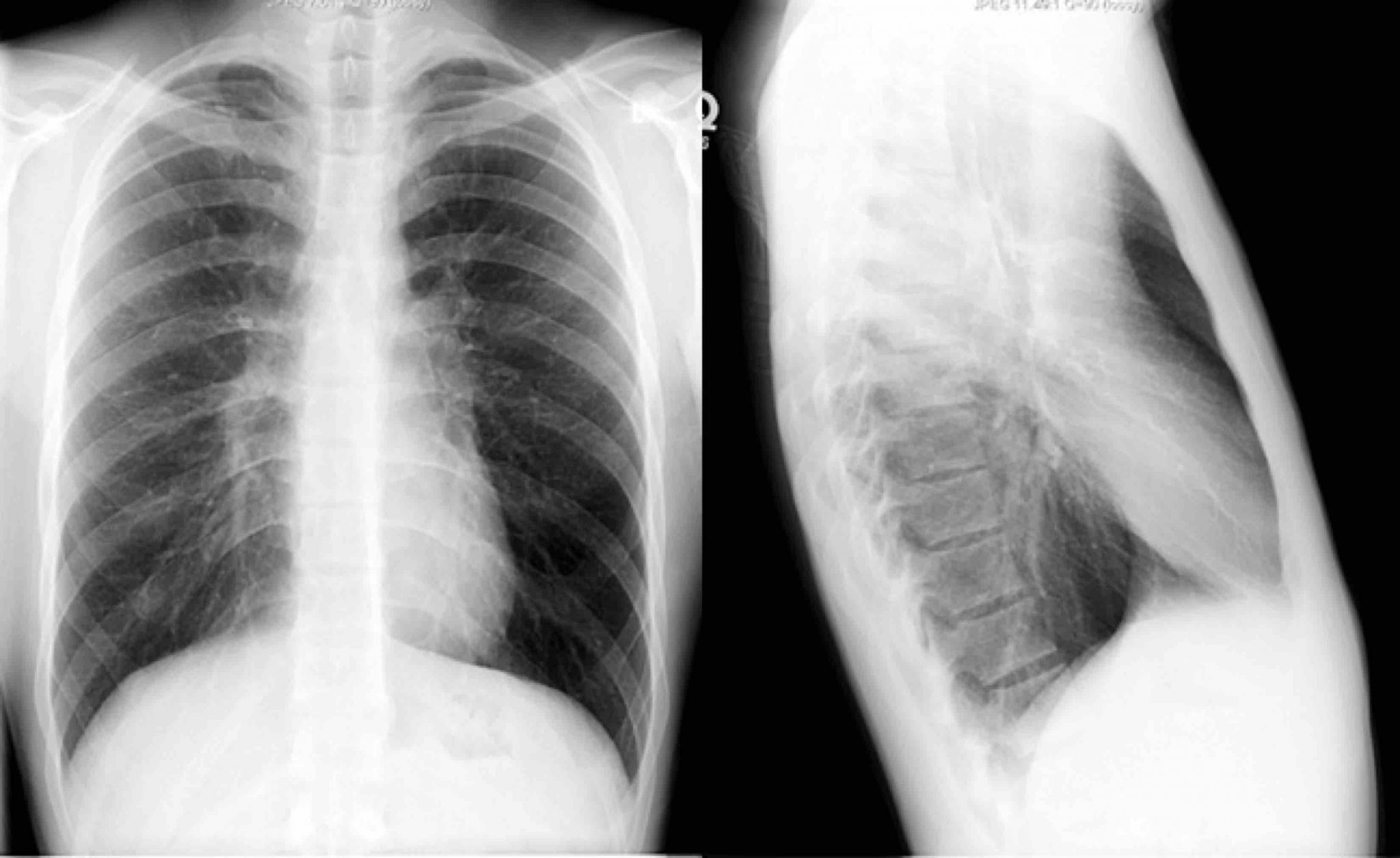 Basic Chest XRay Interpretation Tips and pointers to see it all!