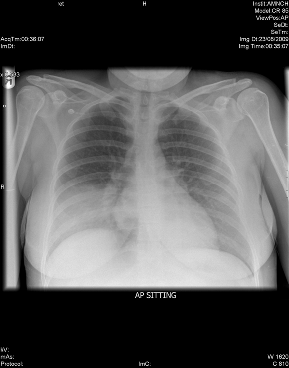 Basic Chest XRay Interpretation Tips and pointers to see it all!
