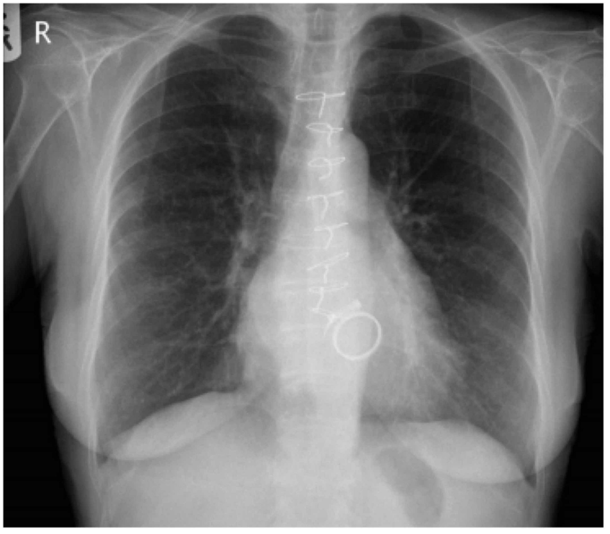 Basic Chest XRay Interpretation Tips and pointers to see it all!
