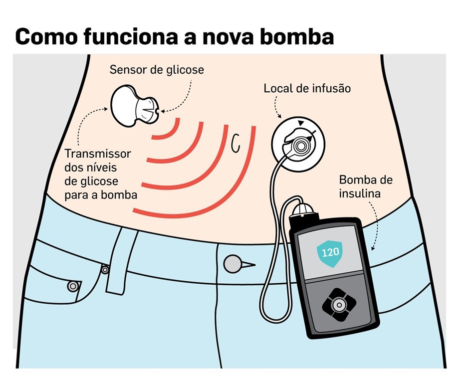 MiniMed 670G Dispositivo que funciona como um pâncreas artificial
