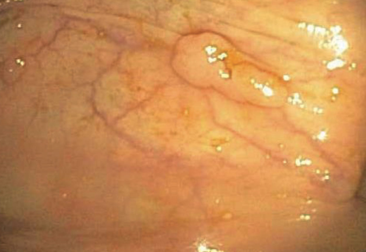 Attenuated Familial Adenomatous Polyposis A Novel Treatment with