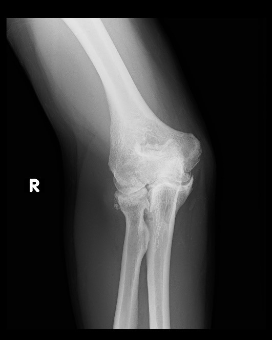 Elbow Arthritis Symptoms, Causes, and Treatments in Abu Dhabi