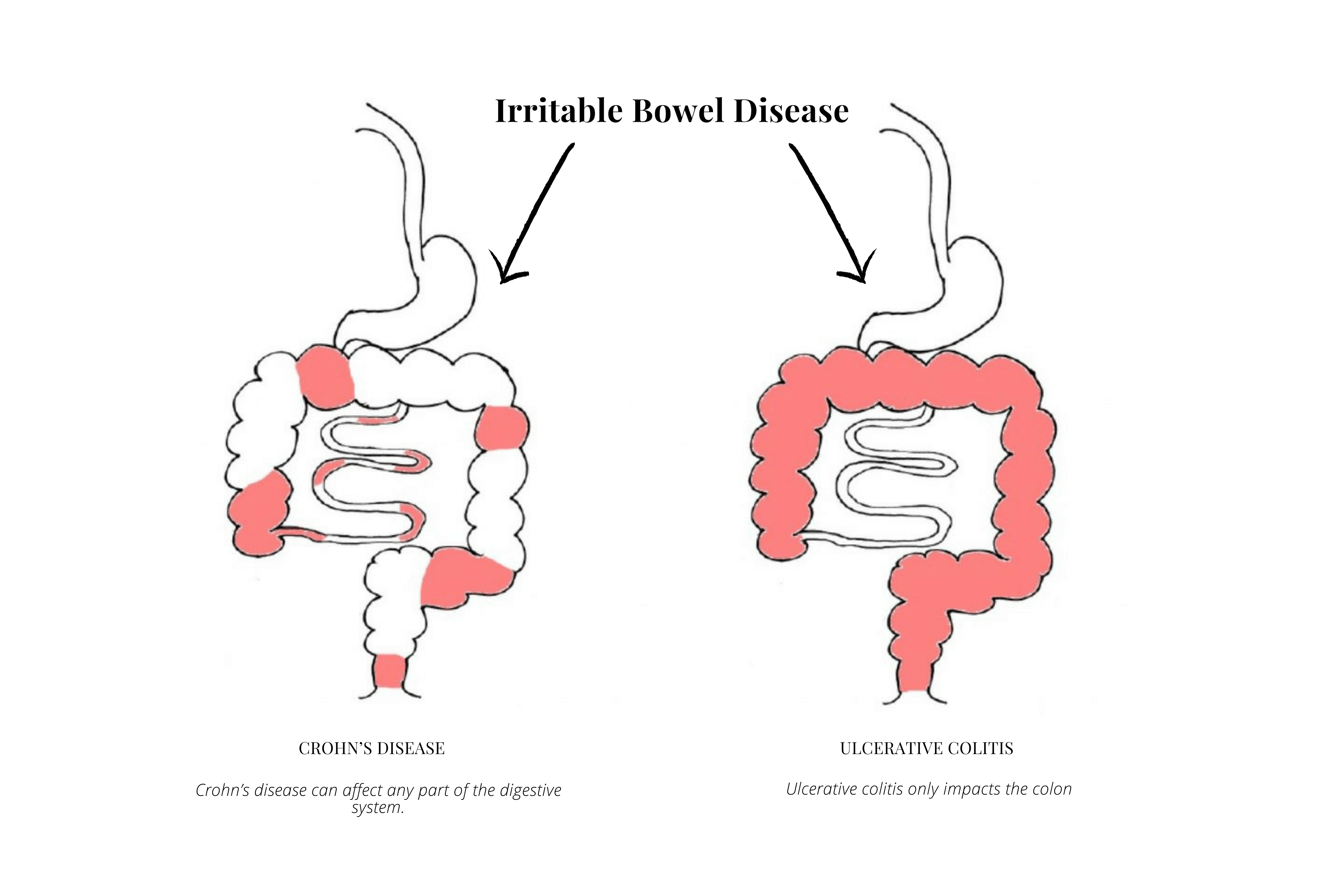 The Ecoli Strain 'Nissle 1917' (Mutaflor) A Powerful Probiotic
