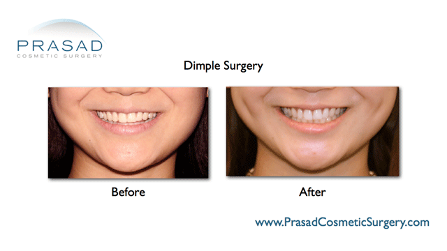 Dimple surgery Dimple Creation Learn More New York