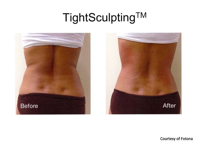 Body Laser Skin Tightening Prasad Cosmetic Surgery NYC