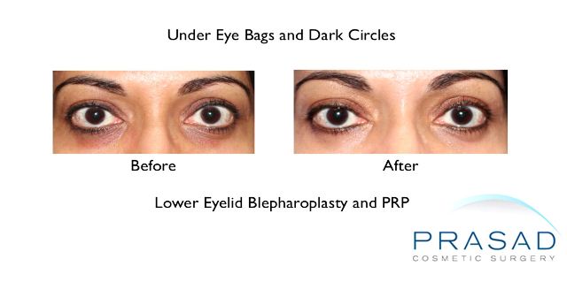 PlateletRich Plasma Injectables New York Garden City