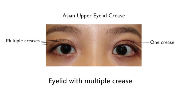 Asian Eyelid Surgery Double Eyelid Surgery Specialist NY