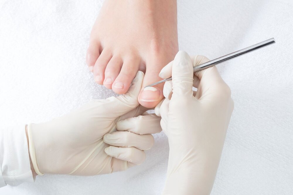 Onyfix Nail Correction Specialists Praxis Podiatry