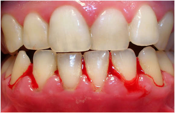 Do Your Gums Bleed? How to Deal with it? Precious Smiles