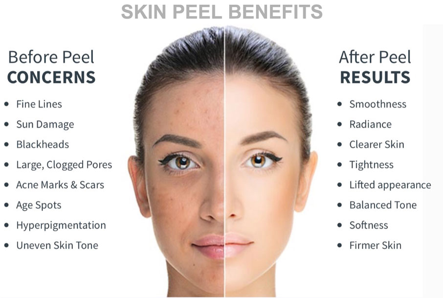 Chemical Peel for a Better Skin Appearance