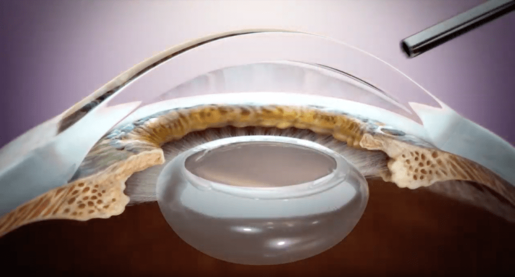 Complex Eye Procedures, Referrals & Second Opinions Precision Eye