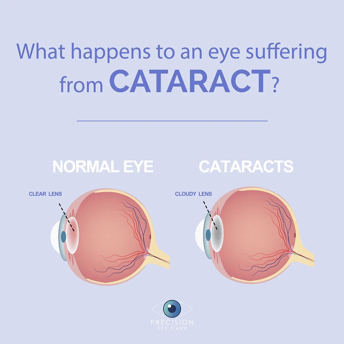 Cataract Eye Precision Eye Cataract and Laser Eye Surgery