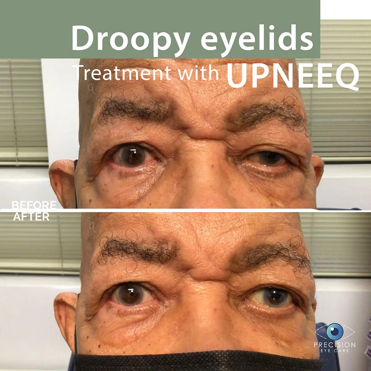 Upneeq Precision Eye Cataract and Laser Eye Surgery Optometrist