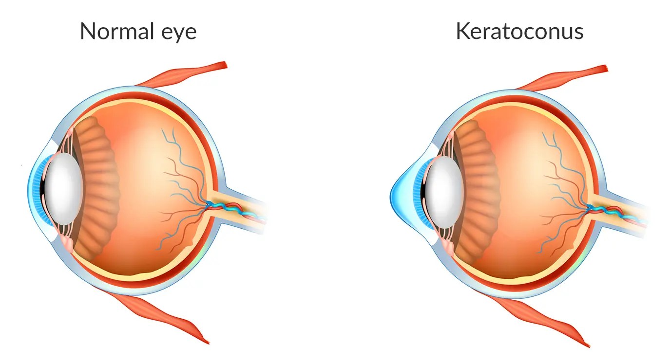 Keratoconus Precision Eye Cataract and Laser Eye Surgery