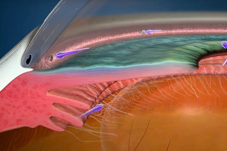 Elevated intraocular pressure Archives Precision Eye Cataract and
