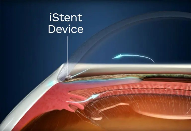 What is Elevated intraocular pressure (IOP) Precision Eye Care MD