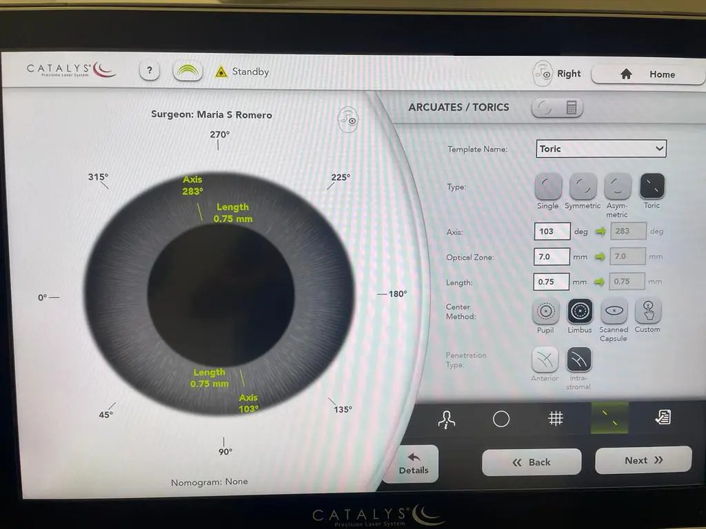 Astigmatism correction at the time of cataract surgery Precision Eye MD